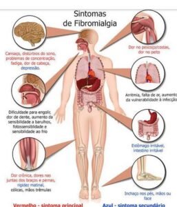 sintomas fibromialgia